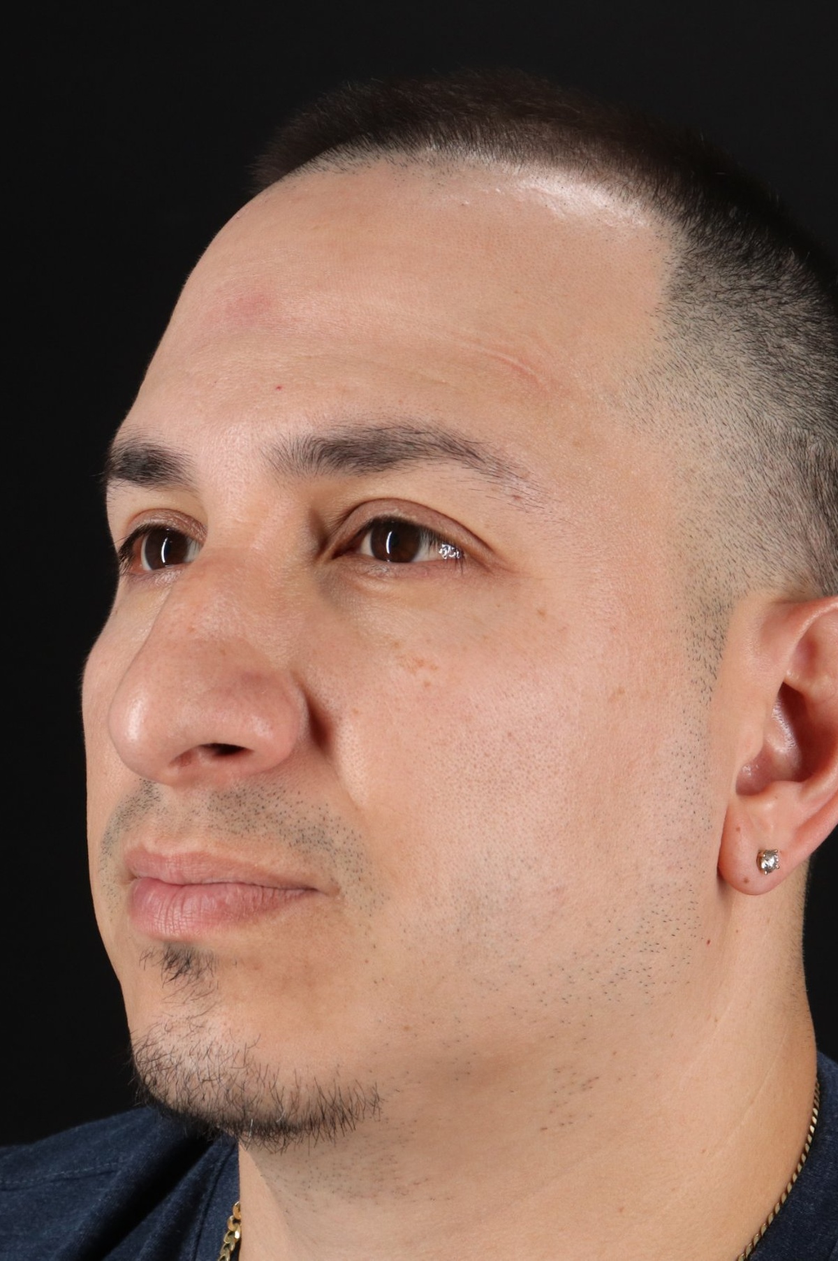 Rhinoplasty Before & After Patient #5518