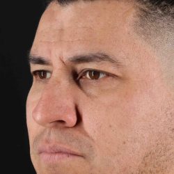 Rhinoplasty Before & After Patient #5519
