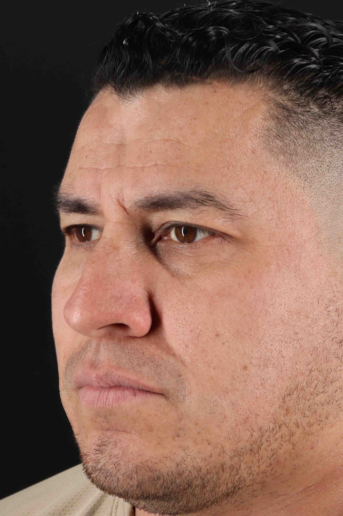 Rhinoplasty Before & After Patient #5519