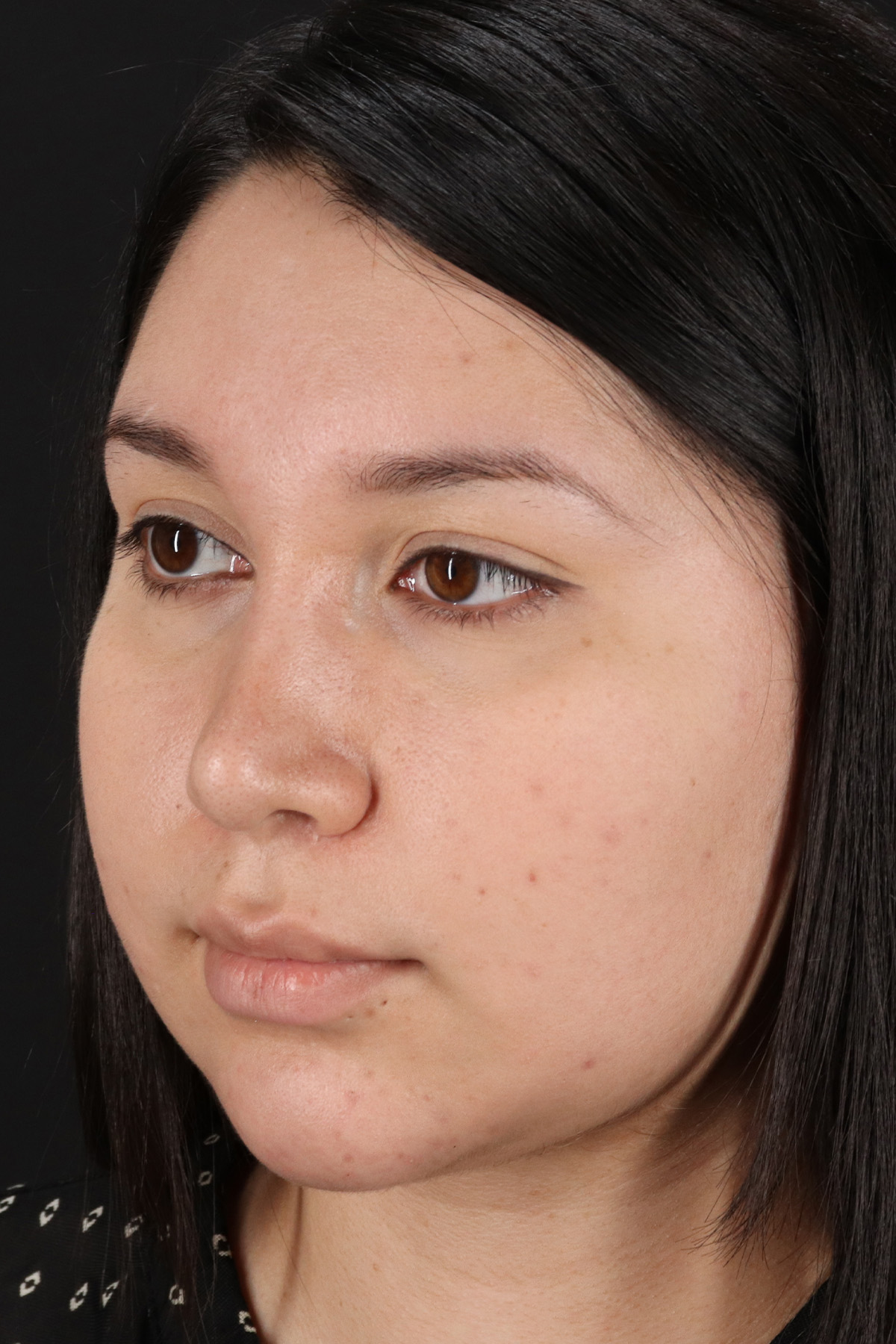 Neck Lift Before & After Patient #5395