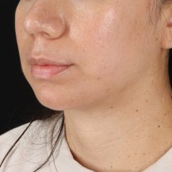 Neck Lift Before & After Patient #5396