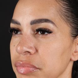 Chin Implant Before & After Patient #5390
