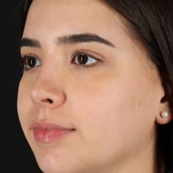 Chin Implant Before & After Patient #5391