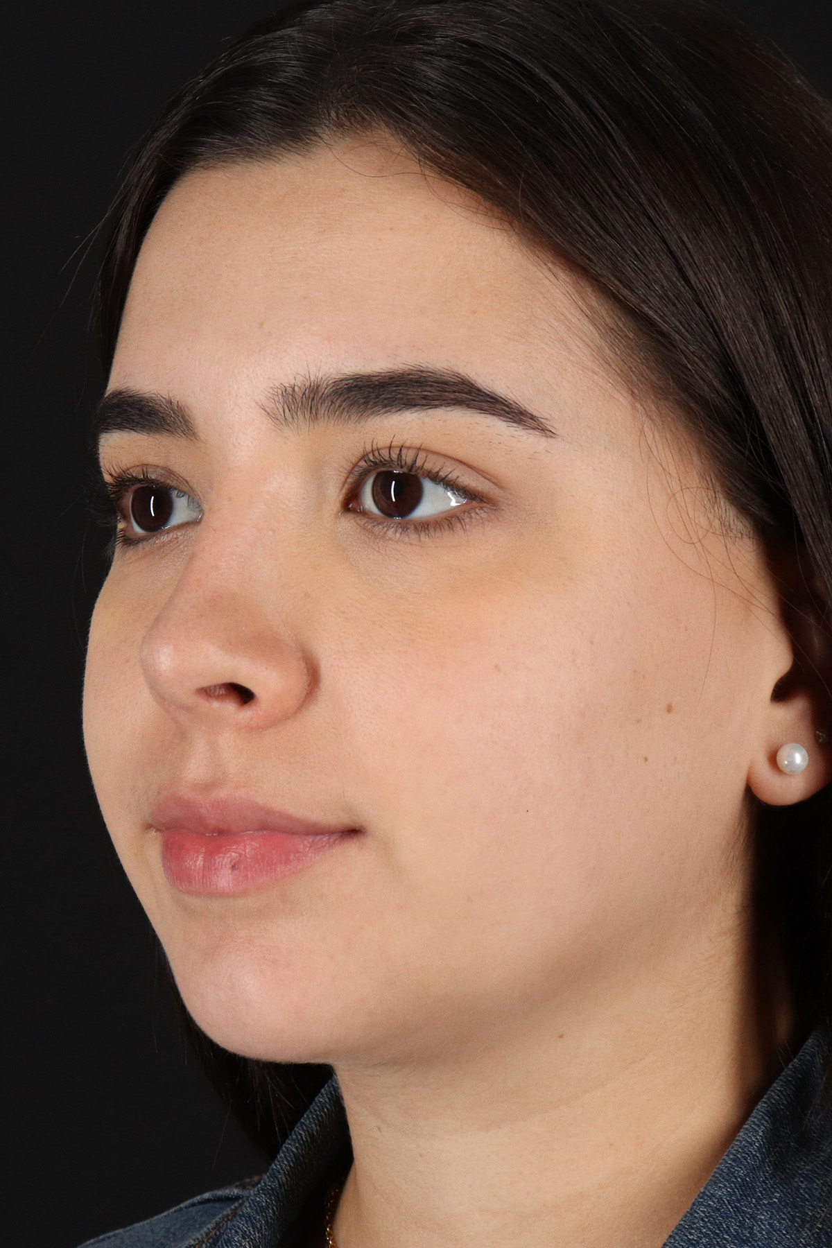 Chin Implant Before & After Patient #5391