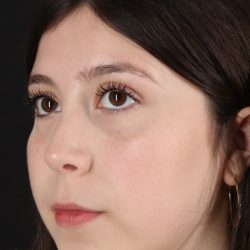 Rhinoplasty Before & After Patient #5575