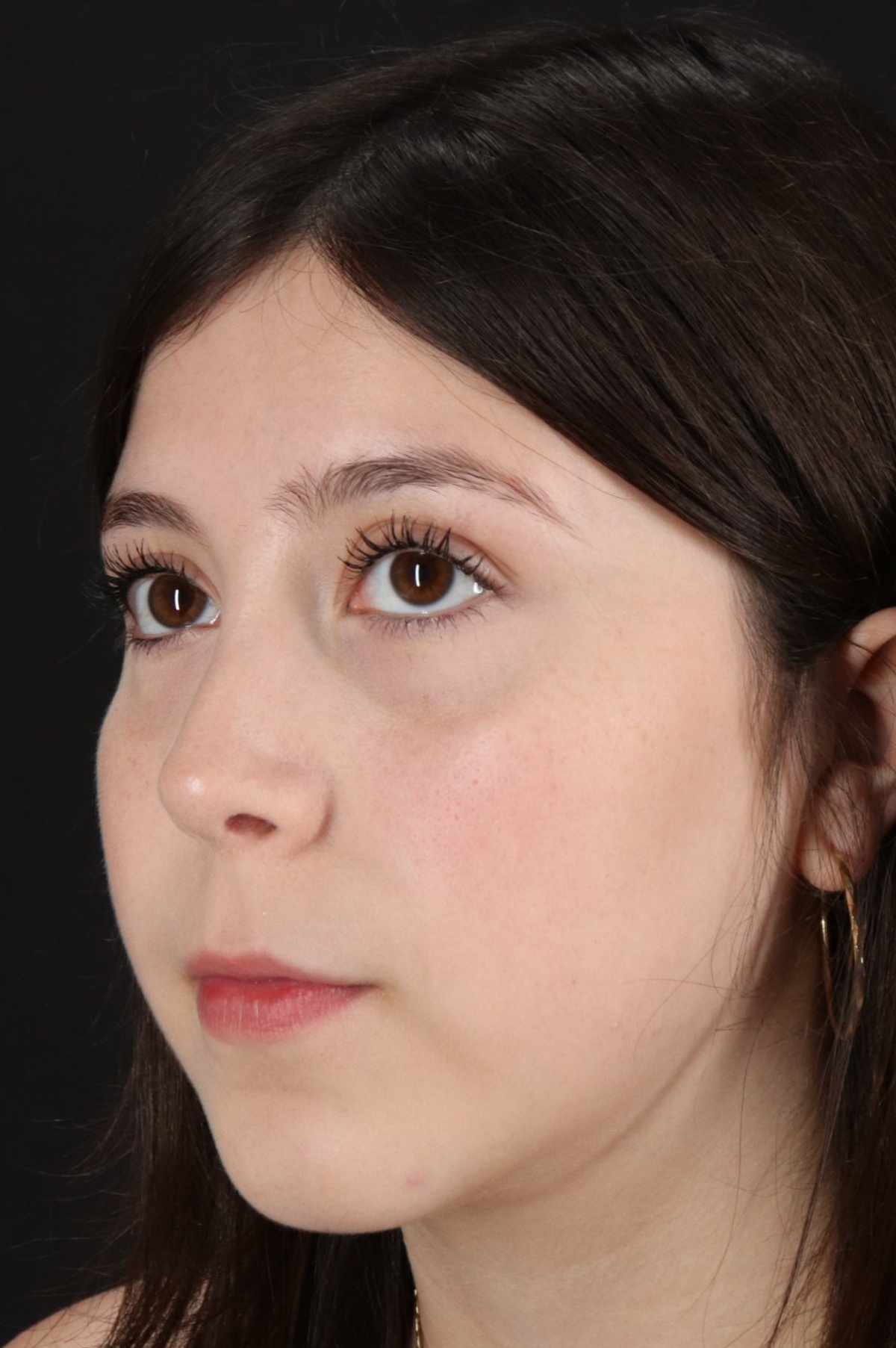 Rhinoplasty Before & After Patient #5575