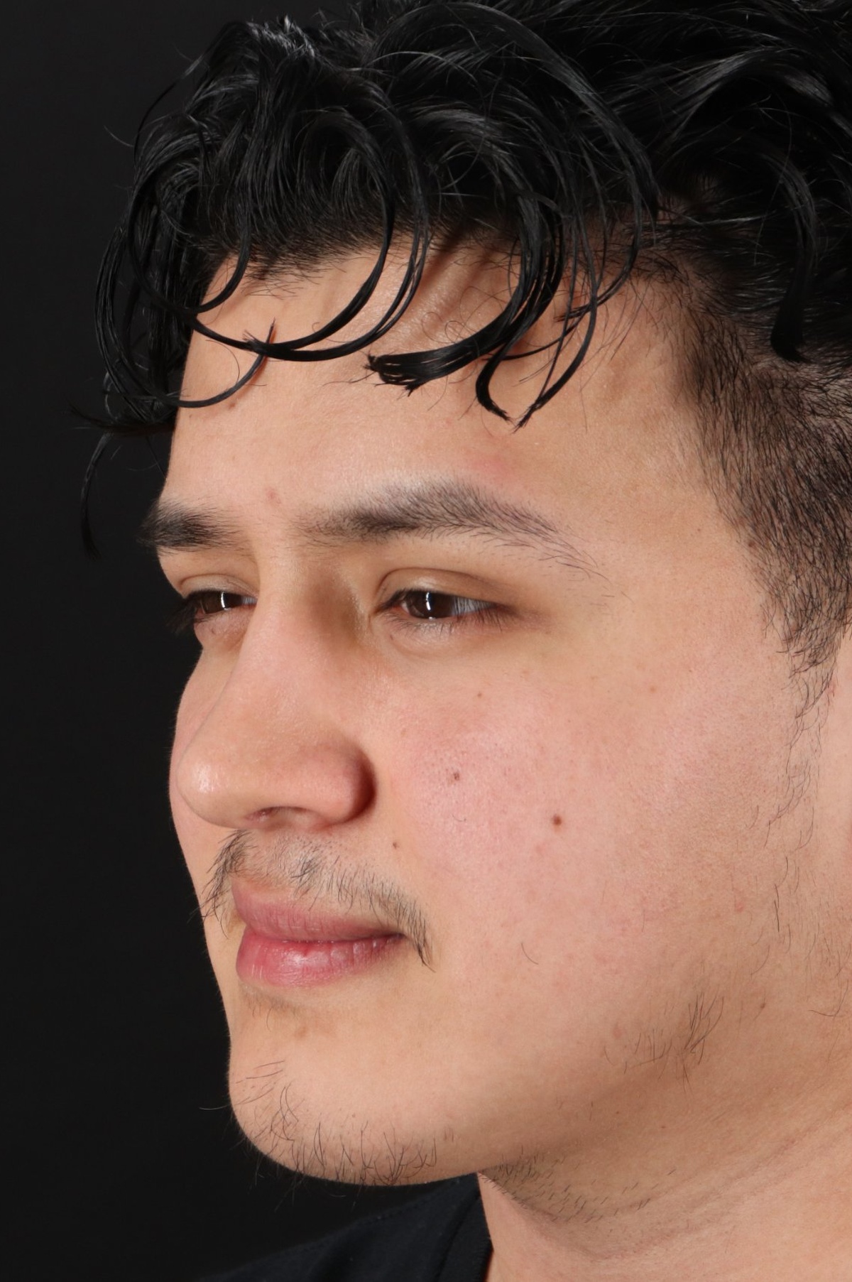 Rhinoplasty Before & After Patient #5516