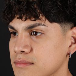 Rhinoplasty Before & After Patient #5517