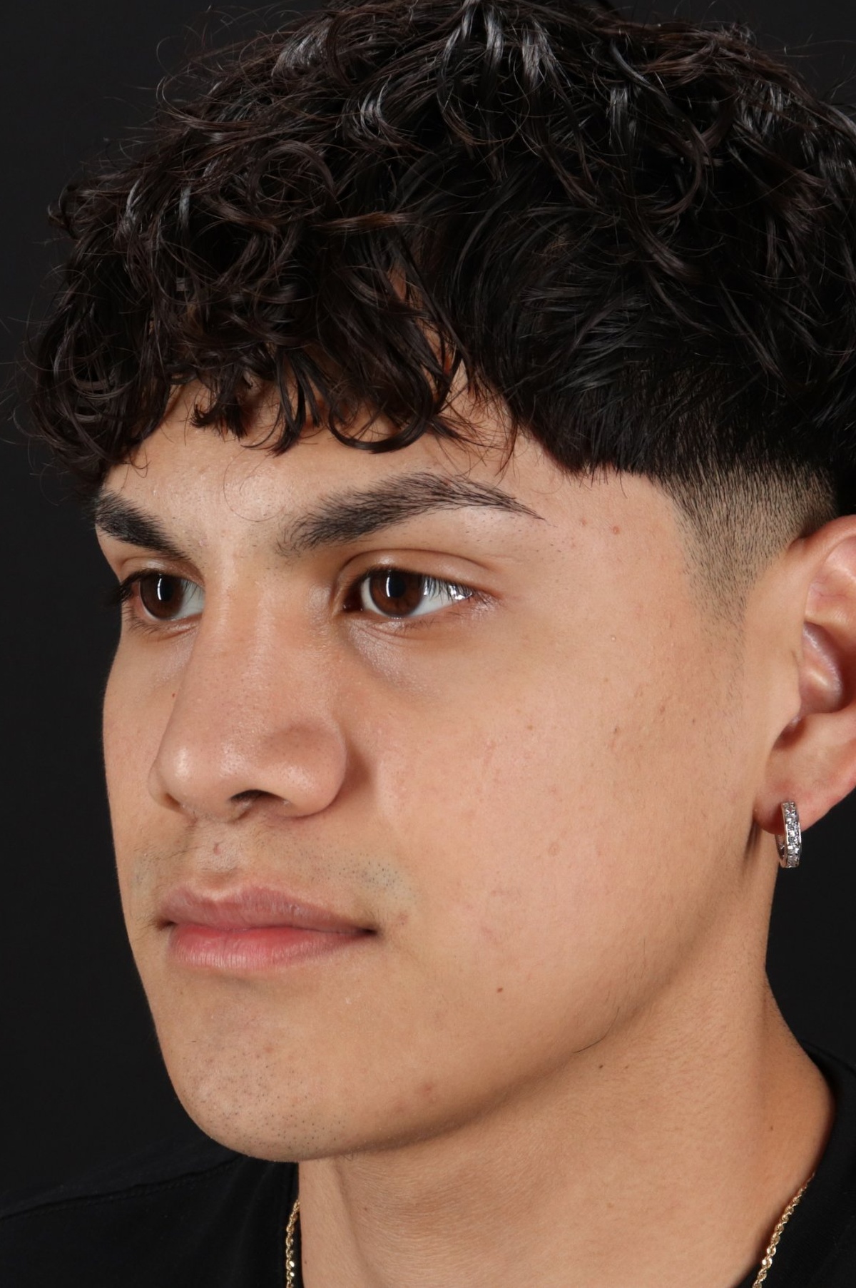 Rhinoplasty Before & After Patient #5517