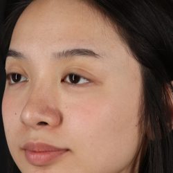 Rhinoplasty Before & After Patient #5573