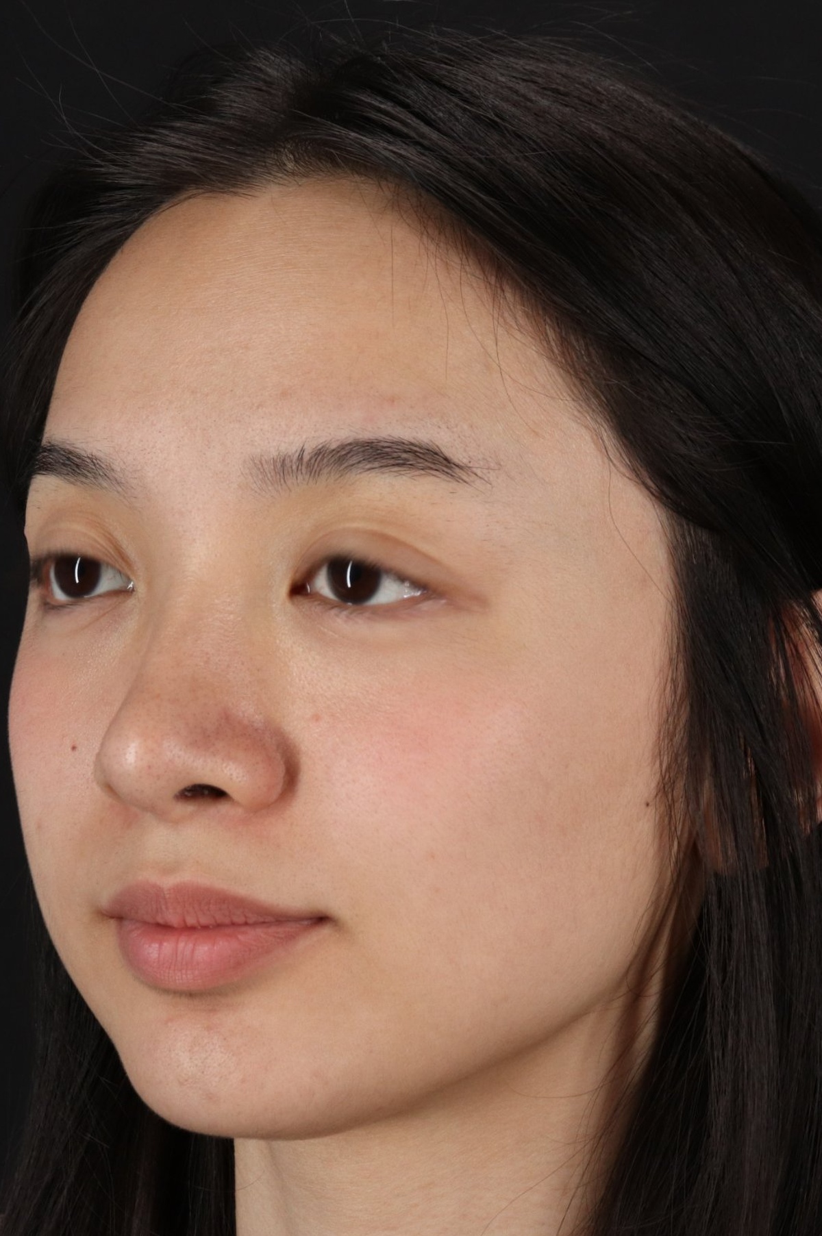 Rhinoplasty Before & After Patient #5573