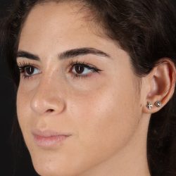 Rhinoplasty Before & After Patient #5572