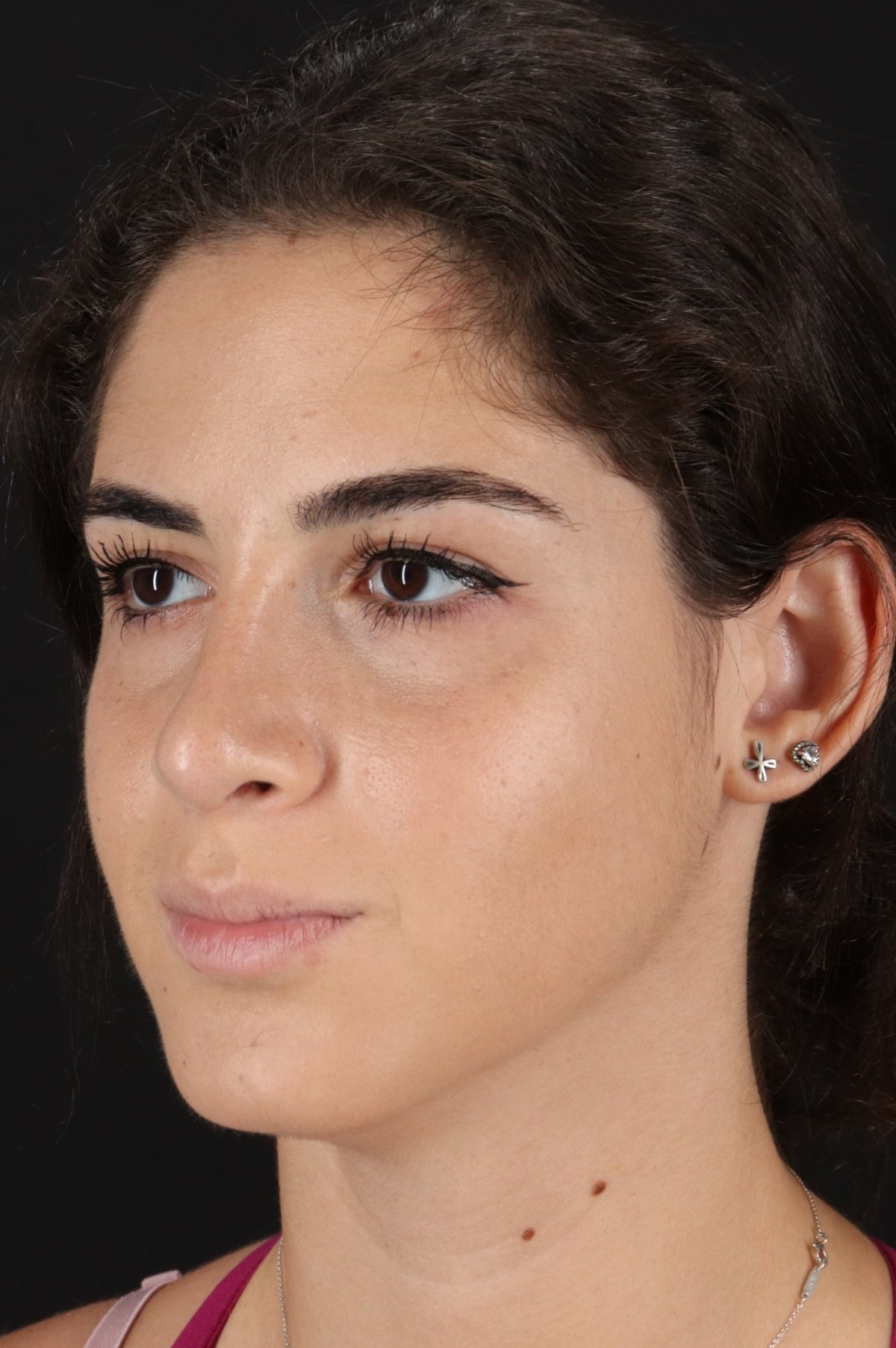 Rhinoplasty Before & After Patient #5572