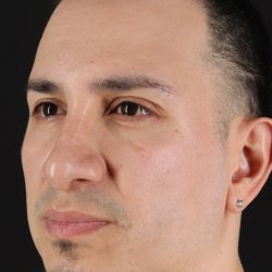 Rhinoplasty Before & After Patient #5518