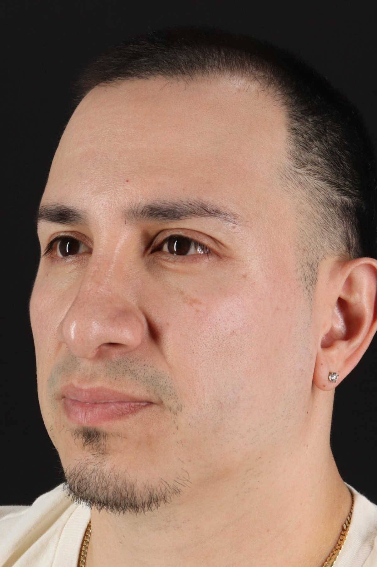 Rhinoplasty Before & After Patient #5518