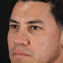 Rhinoplasty Before & After Patient #5519