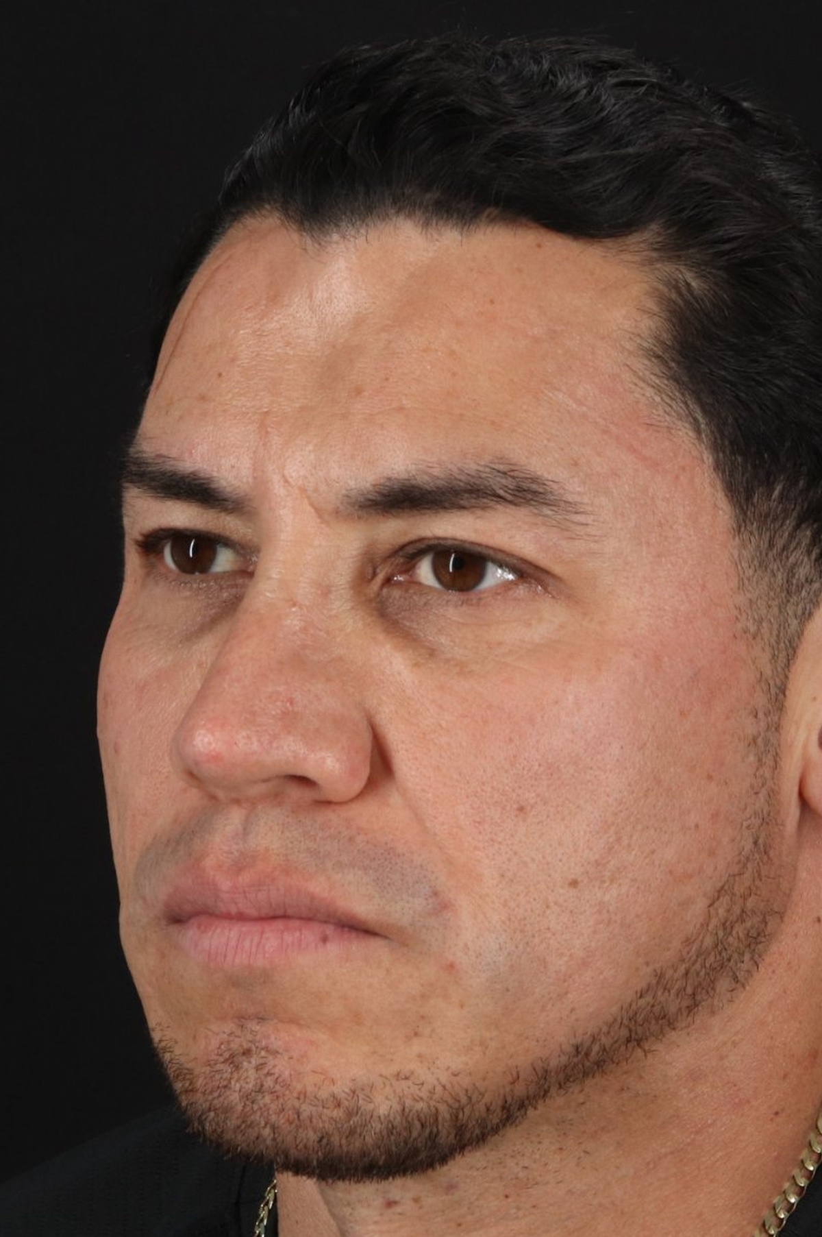 Rhinoplasty Before & After Patient #5519