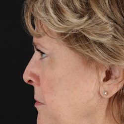 Facelift Before & After Patient #5392