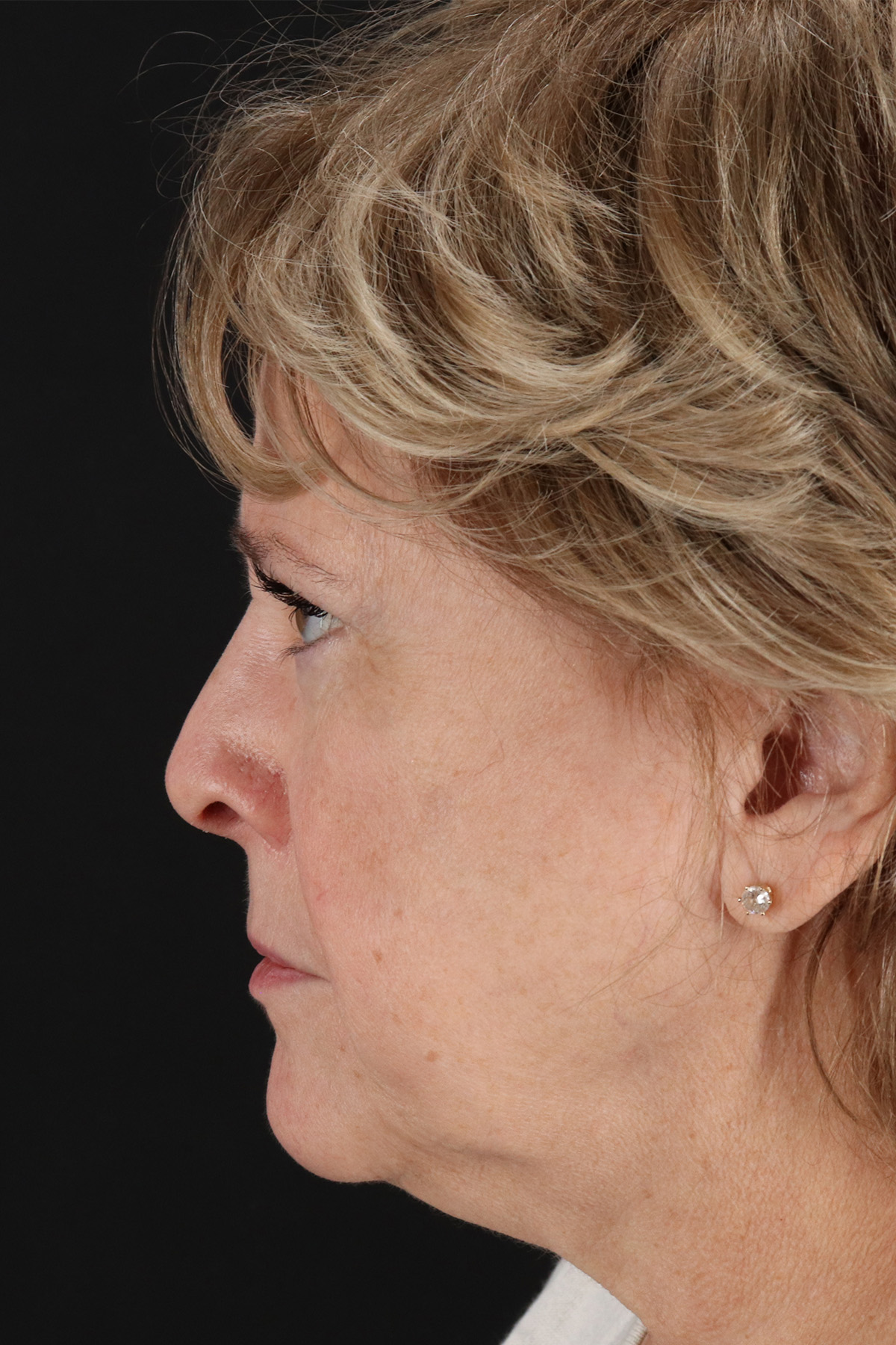 Facelift Before & After Patient #5392