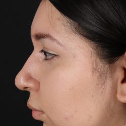 Neck Lift Before & After Patient #5395