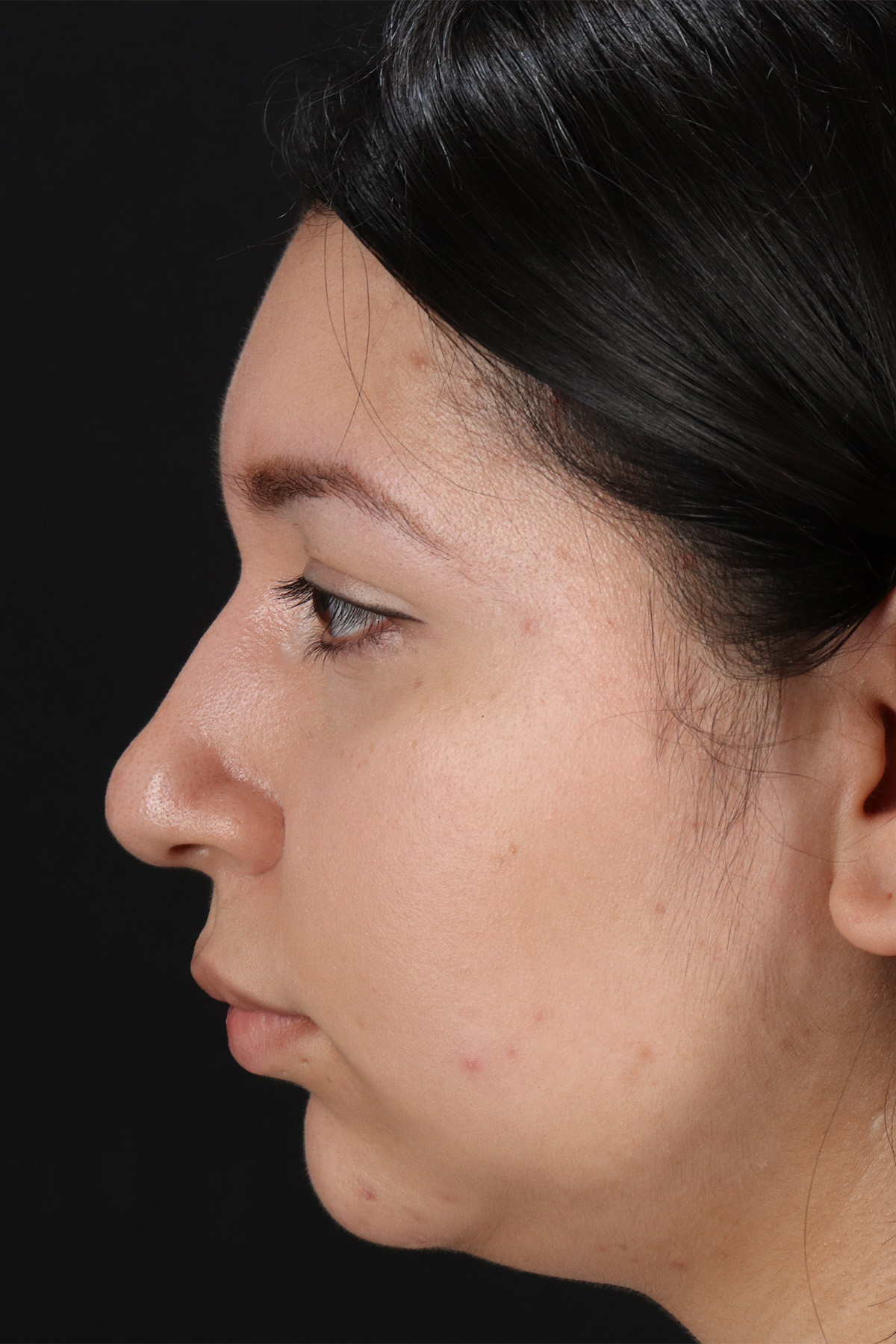 Neck Lift Before & After Patient #5395