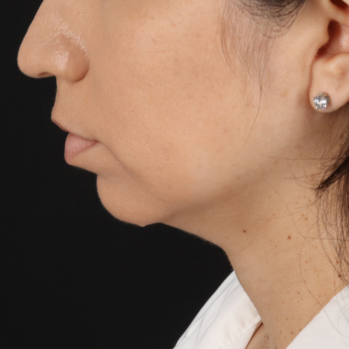 Neck Lift Before & After Patient #5396