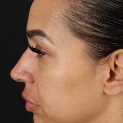Chin Implant Before & After Patient #5390