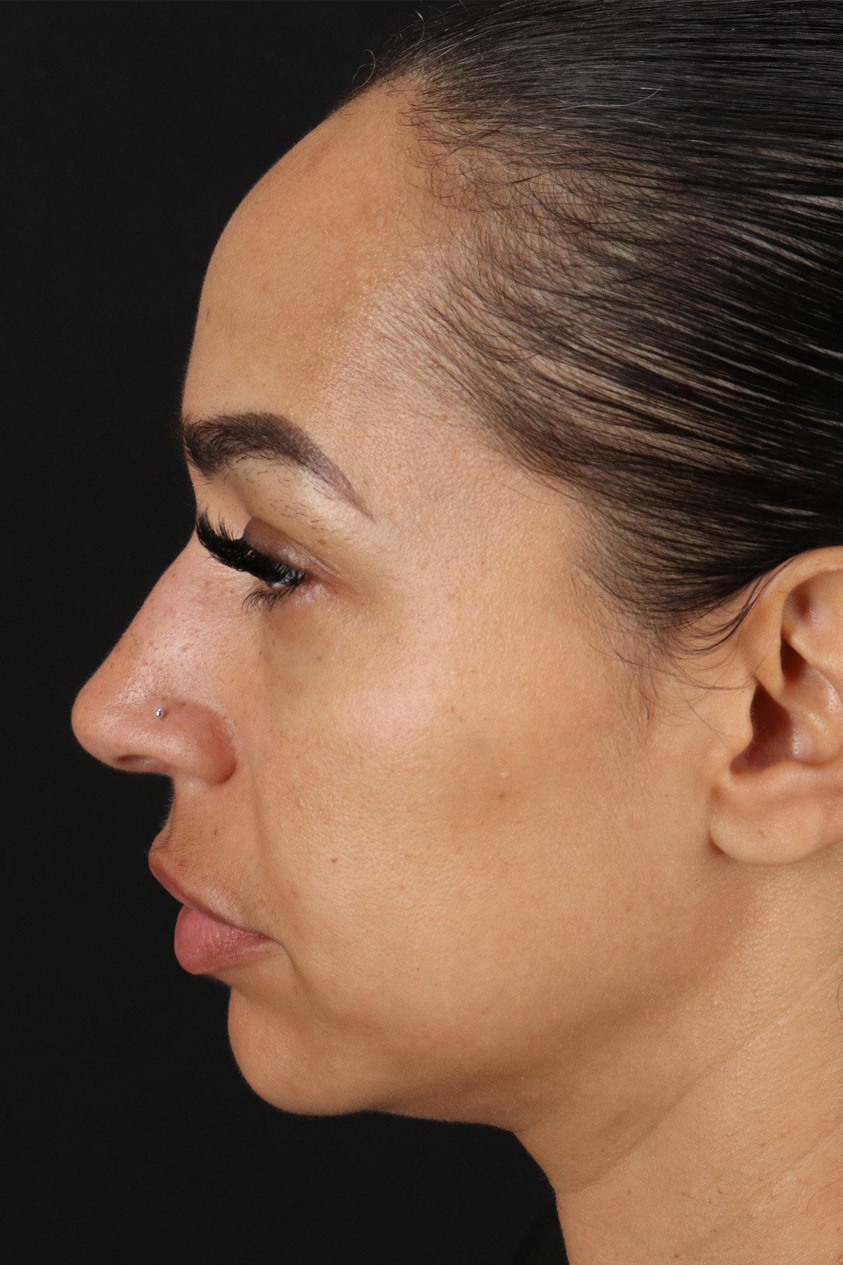 Chin Implant Before & After Patient #5390