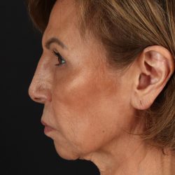 Facelift Before & After Patient #5394
