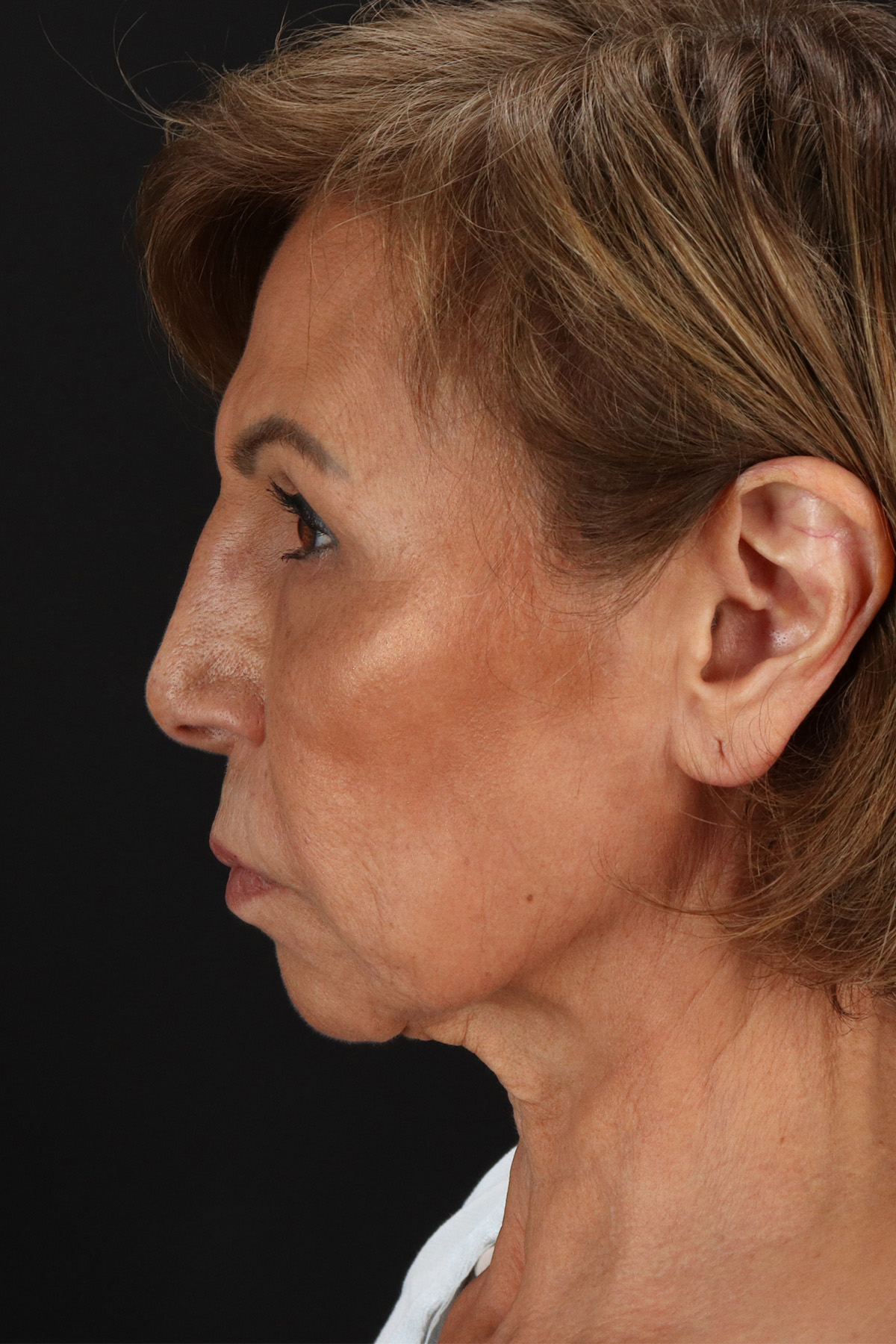 Facelift Before & After Patient #5394