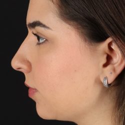 Chin Implant Before & After Patient #5391