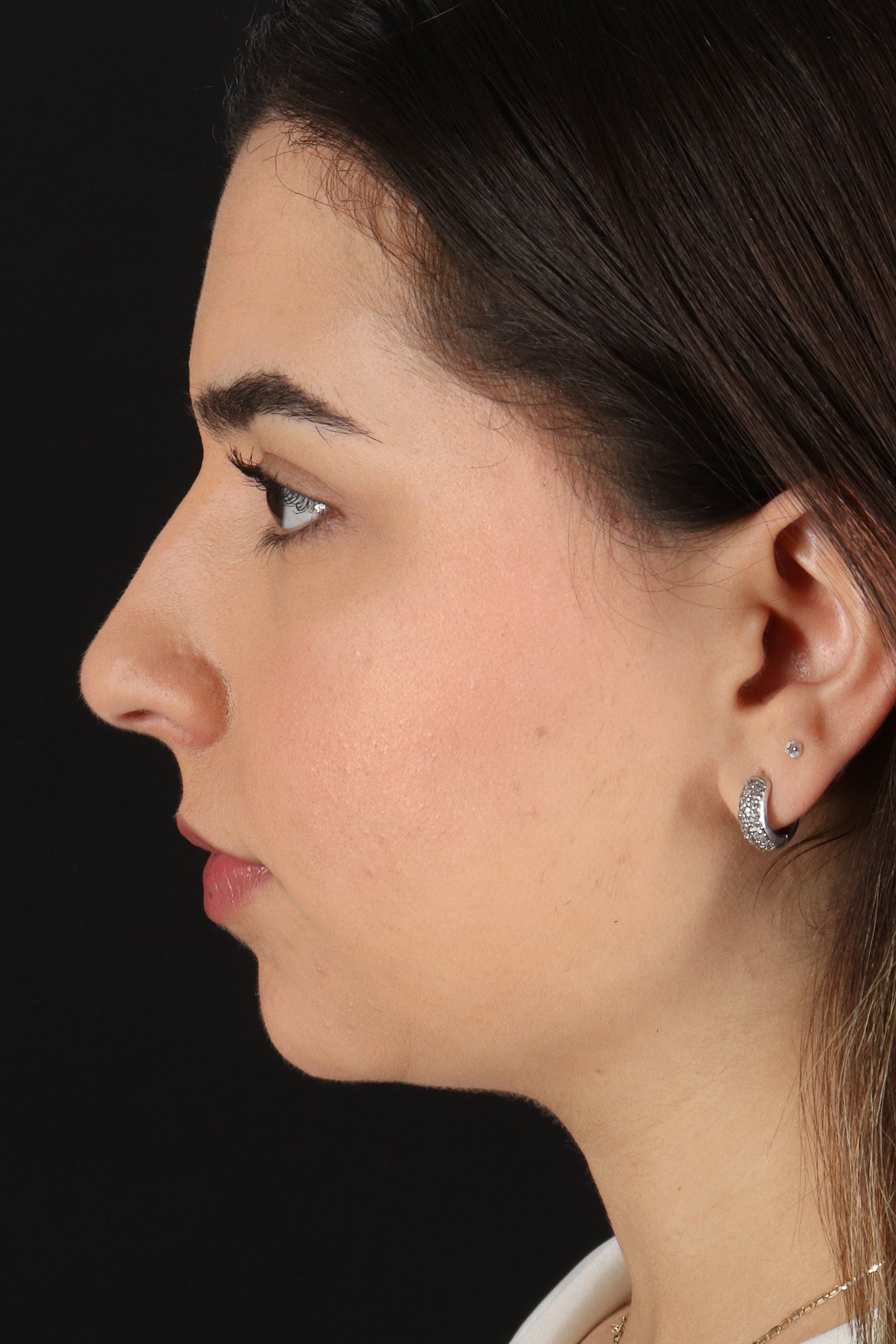 Chin Implant Before & After Patient #5391