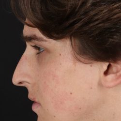 Rhinoplasty Before & After Patient #5515