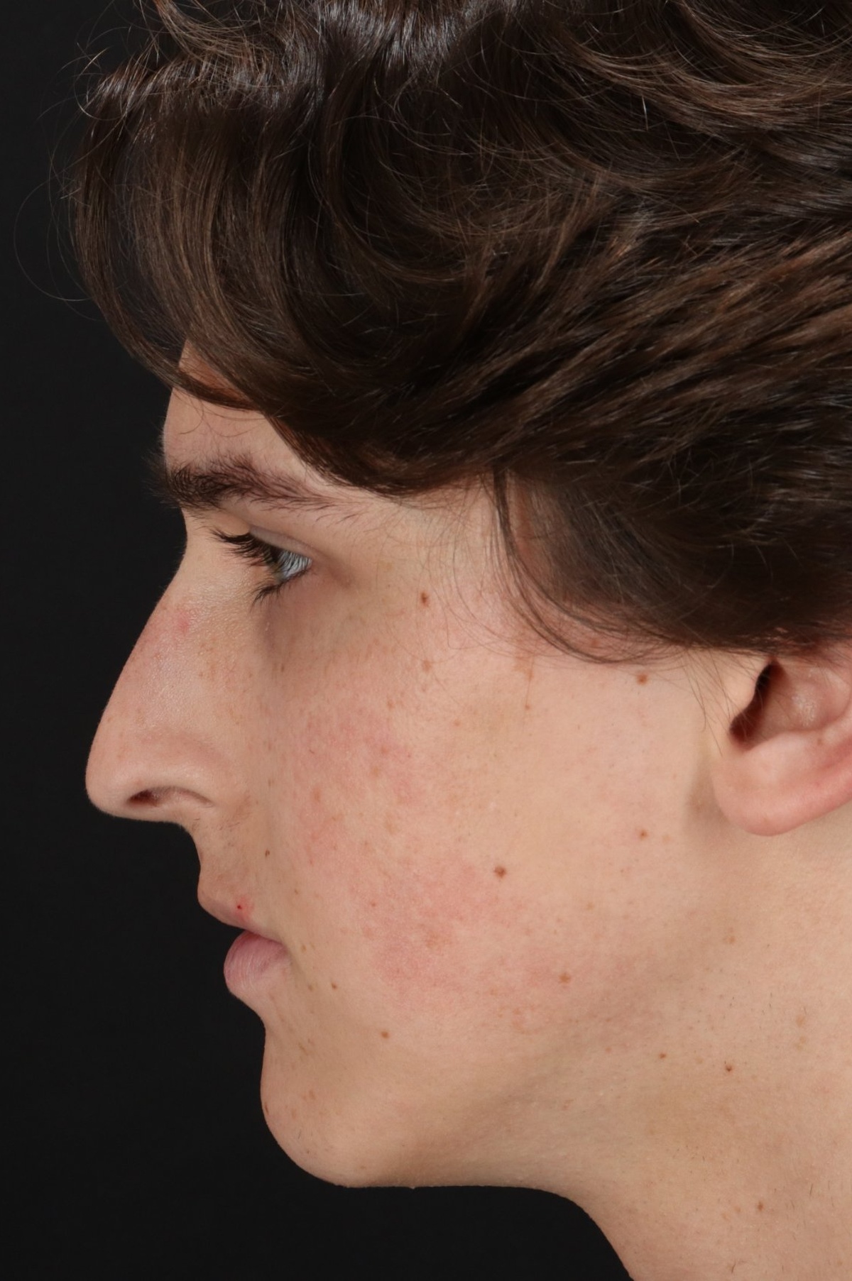 Rhinoplasty Before & After Patient #5515