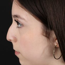 Rhinoplasty Before & After Patient #5575