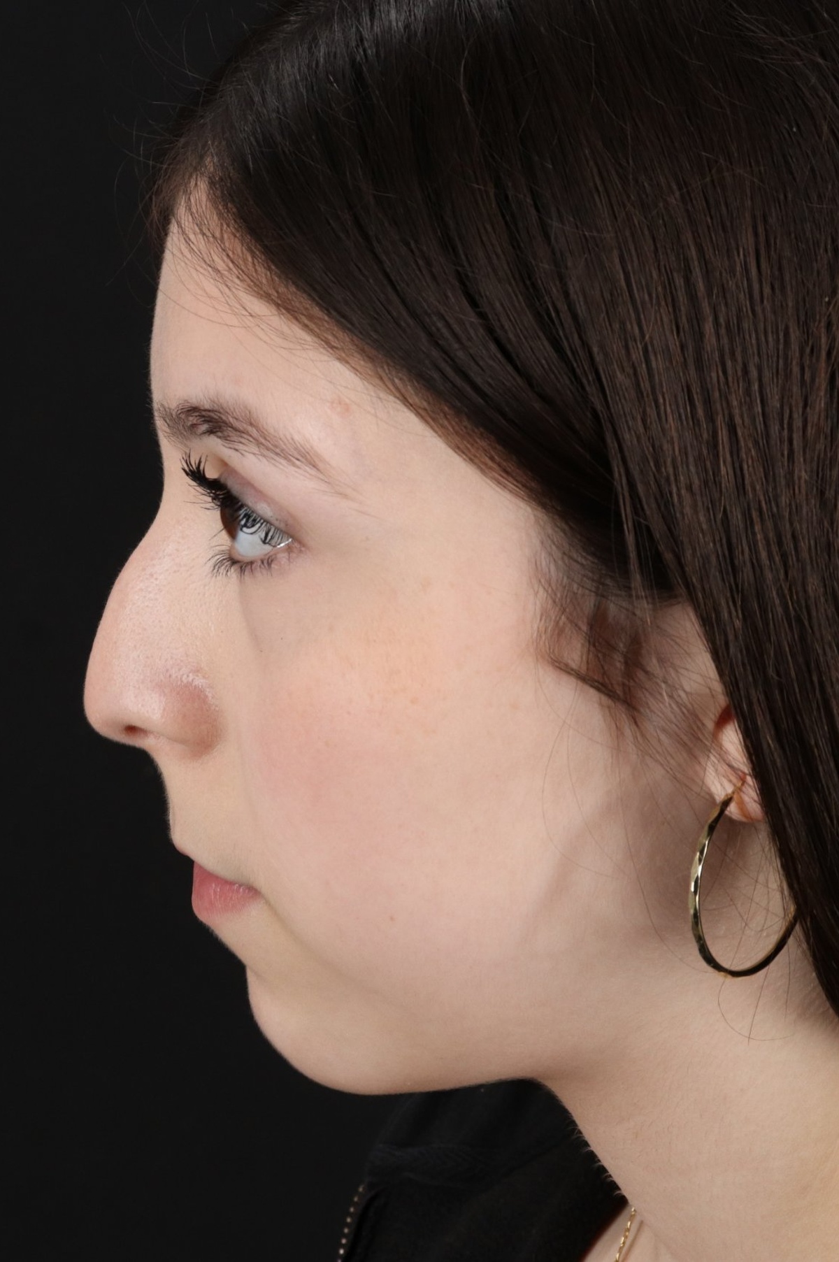 Rhinoplasty Before & After Patient #5575