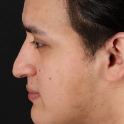 Rhinoplasty Before & After Patient #5516