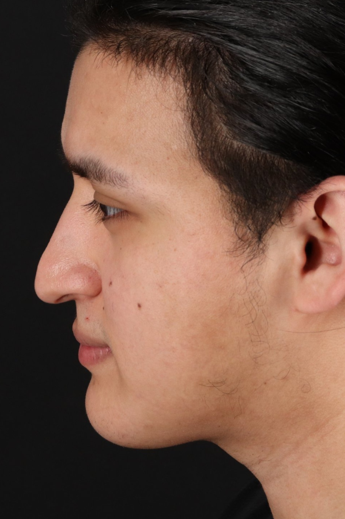 Rhinoplasty Before & After Patient #5516