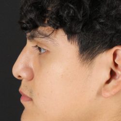 Rhinoplasty Before & After Patient #5517