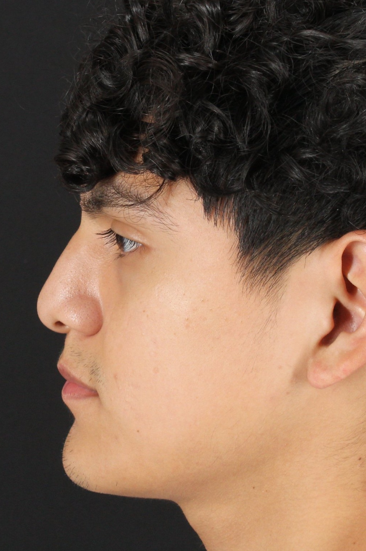 Rhinoplasty Before & After Patient #5517