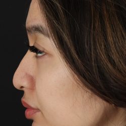 Rhinoplasty Before & After Patient #5573