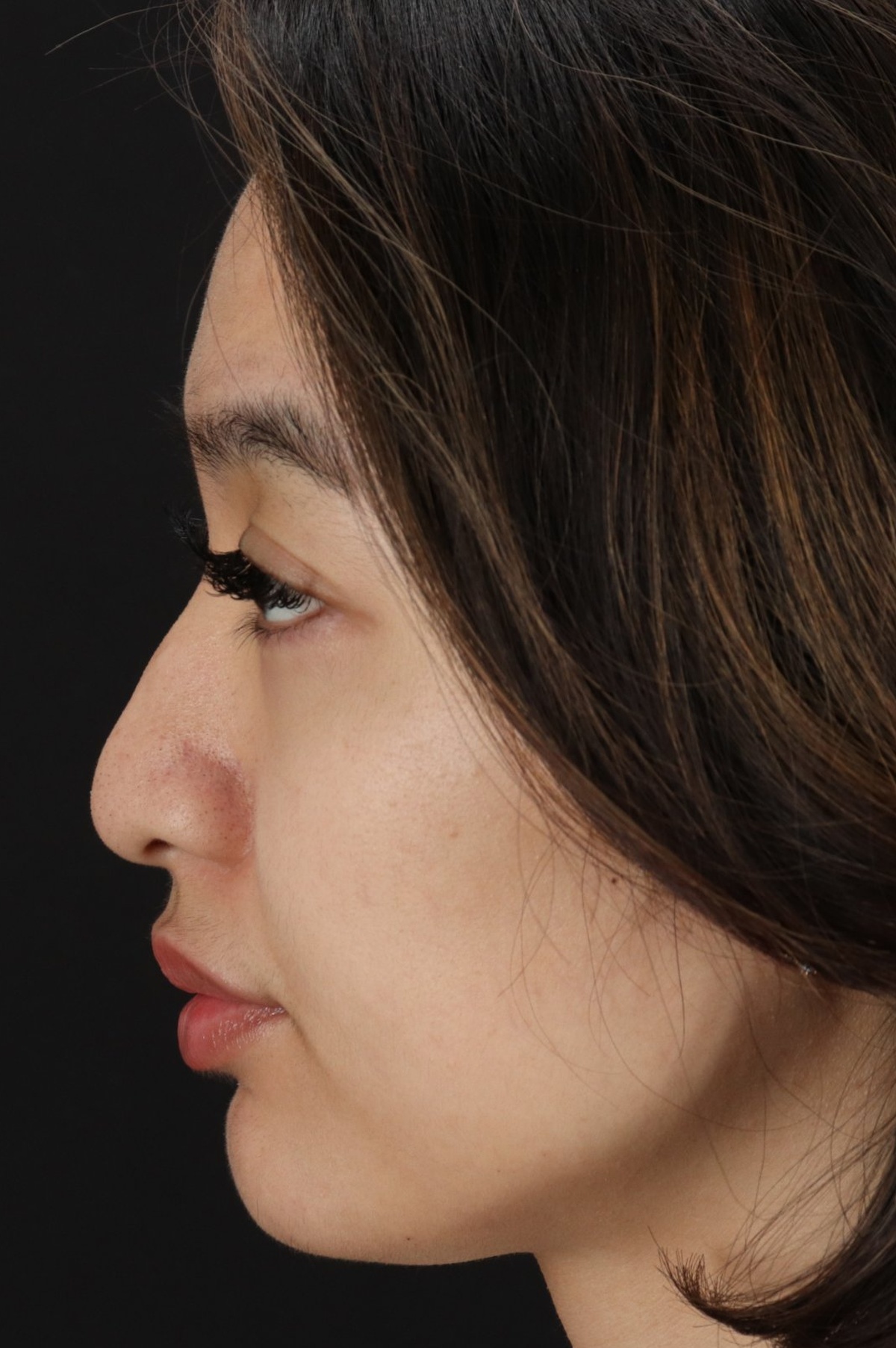 Rhinoplasty Before & After Patient #5573