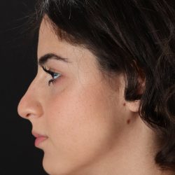 Rhinoplasty Before & After Patient #5572