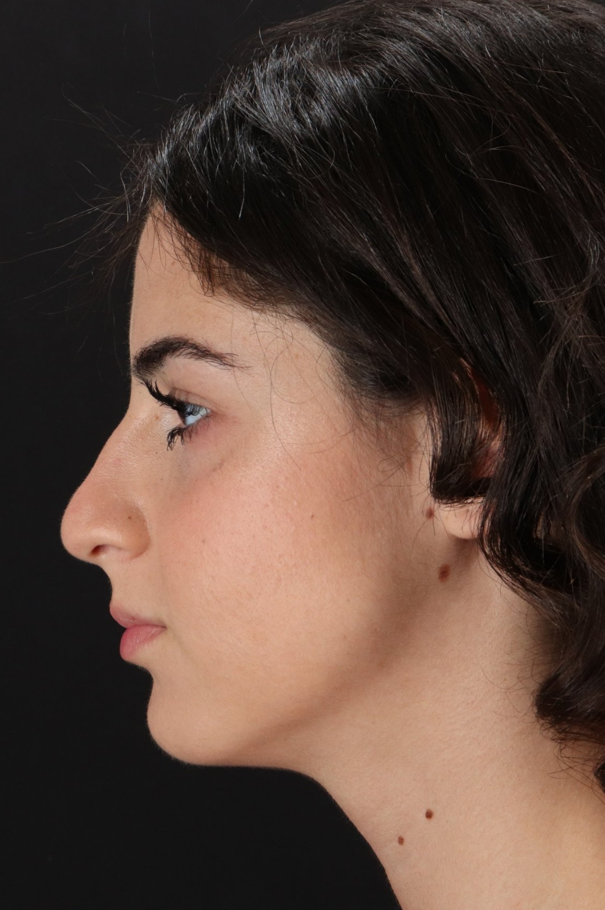 Rhinoplasty Before & After Patient #5572