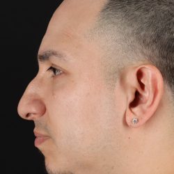 Rhinoplasty Before & After Patient #5518