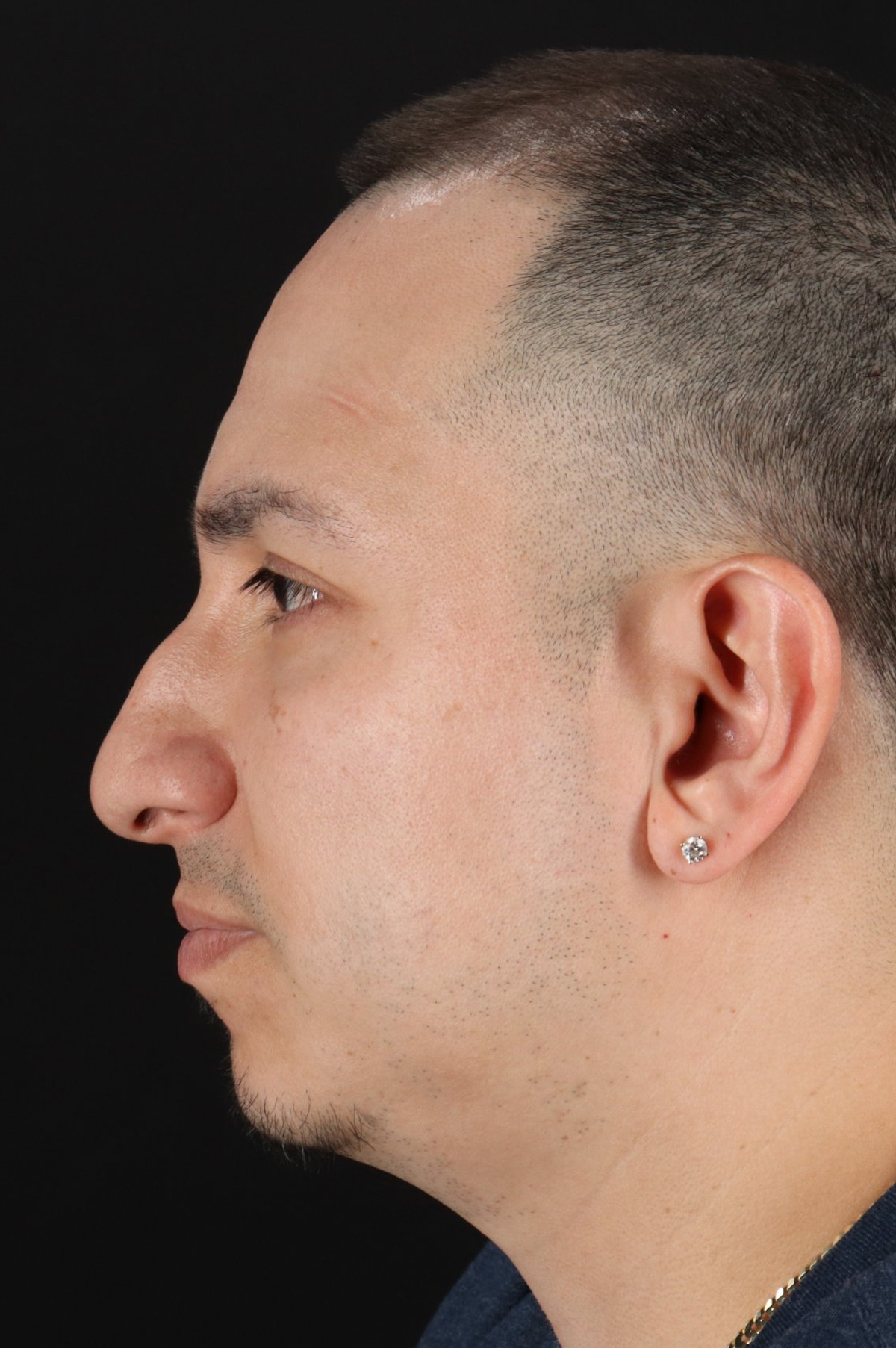 Rhinoplasty Before & After Patient #5518