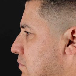 Rhinoplasty Before & After Patient #5519