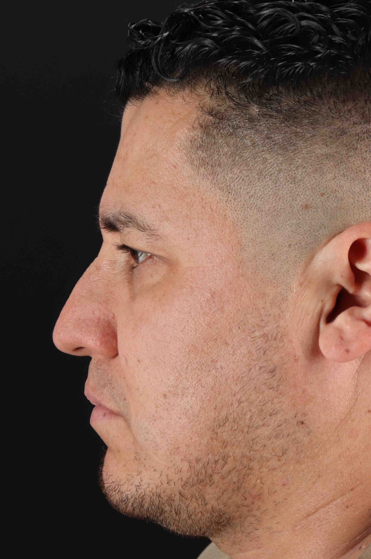 Rhinoplasty Before & After Patient #5519